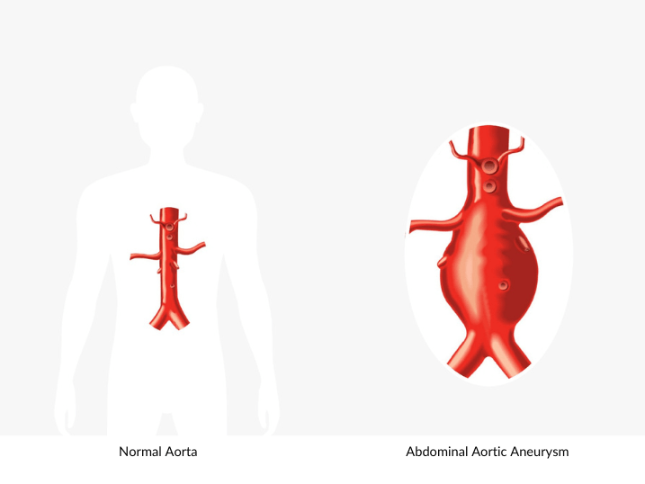 Normal-Aorta-2