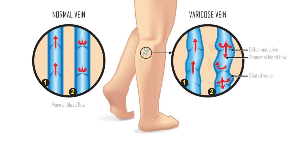 Causes of Varicose Veins