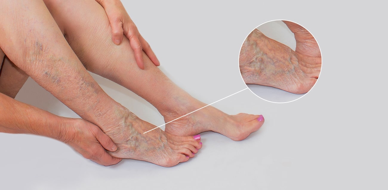 Causes of Varicose Veins