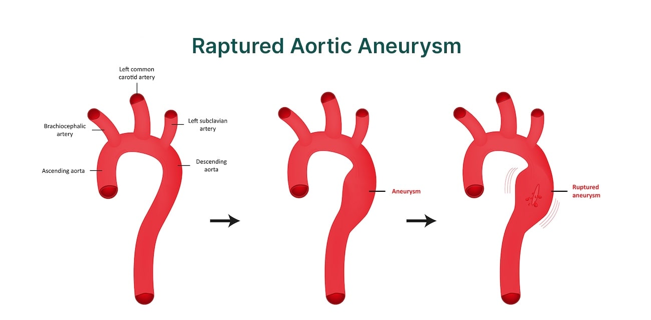 Understanding Aortic Aneurysm Symptoms Causes And Treatments