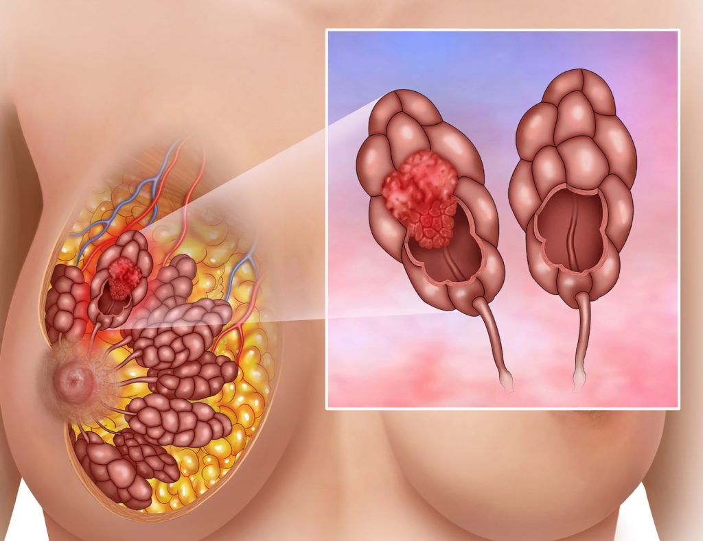 Types of Chemotherapy for Breast Cancer