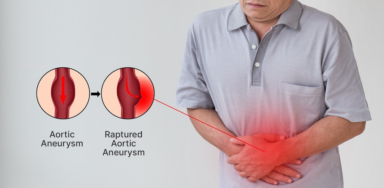 Understanding Aortic Aneurysm